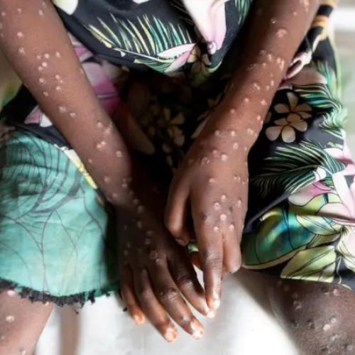 Em 3 meses, Grupo de Vigilância Epidemiológica contabiliza 7 casos de monkeypox em Presidente Prudente